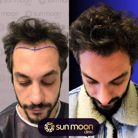 hair-transplant-2.jpg