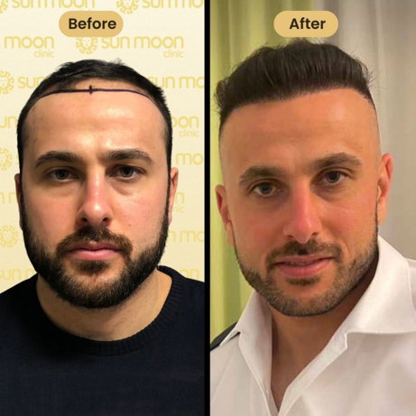 hair-transplant-7.jpg