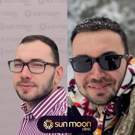 hair-transplant-6.jpg