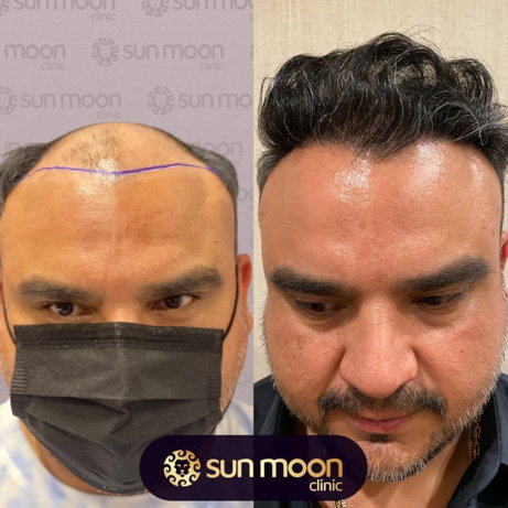 hair-transplant-5.jpg