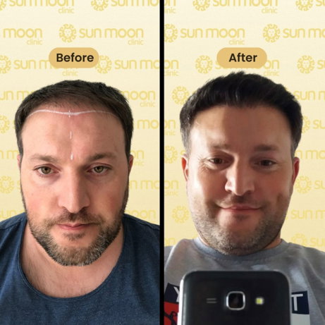 hair-transplant-3.jpg