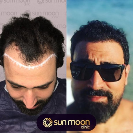 hair-transplant-1.jpg