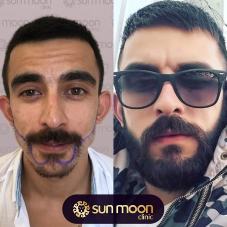 hair-transplant-8.jpg