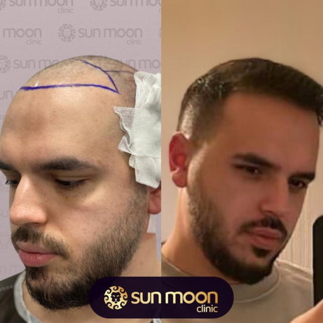 hair-transplant-4.jpg